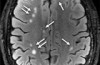 Avanceret Brain Imaging Bedre Kunne Diagnosticere Hjernerystelse