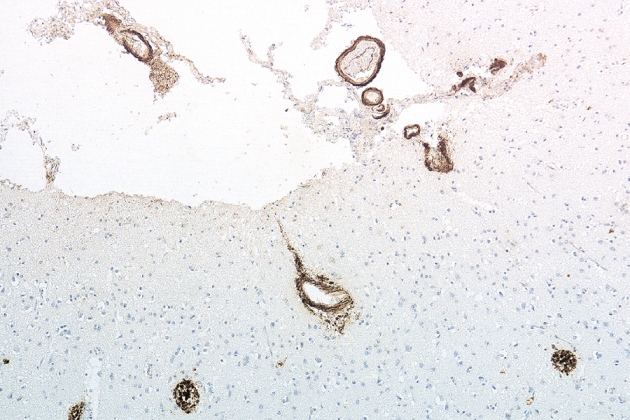 Controversial ‘Transmittable Alzheimer’s’ Theory Is Starting to Look Plausible